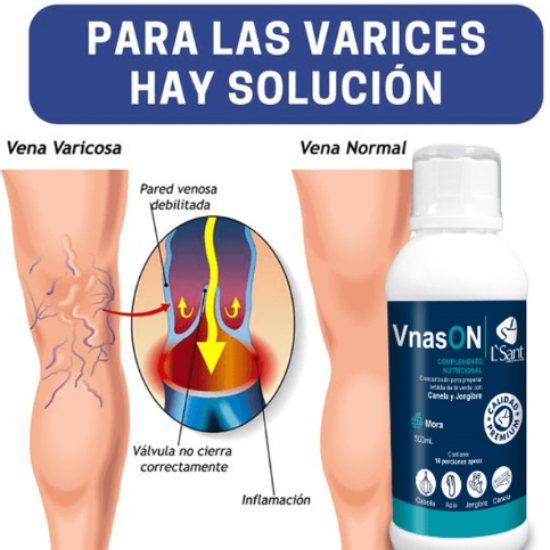 Venas varices vnason – tonne